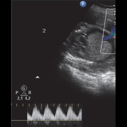 Эхограмма - гемолитическая болезнь плода у дихориальных близнецов - норморезистентный кровоток артерии пуповины первого плода