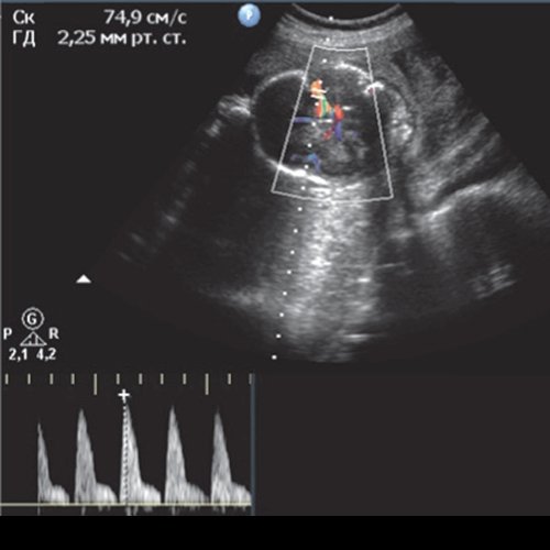 Эхограмма - гемолитическая болезнь плода у дихориальных близнецов - возрастание ПСС СМА первого плода с 70,3 до 83,6 см/с при динамическом наблюдении (л)