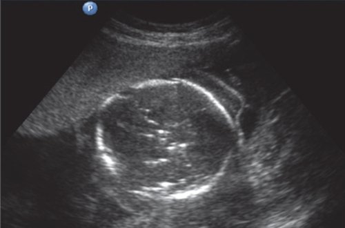 Эхограмма - гемолитическая болезнь плода у дихориальных близнецов - мониторинг после антенатальной гибели первого плода (м)