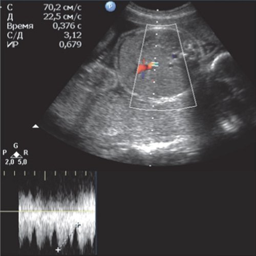 Эхограмма - гемолитическая болезнь плода у дихориальных близнецов - мониторинг после антенатальной гибели первого плода (н)
