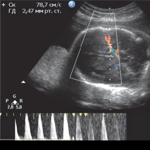 Эхограмма - гемолитическая болезнь плода у дихориальных близнецов - мониторинг после антенатальной гибели первого плода (п)