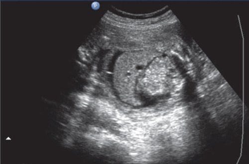 Эхограмма - гемолитическая болезнь плода у дихориальных близнецов - высокоэхогенный кишечник первого плода