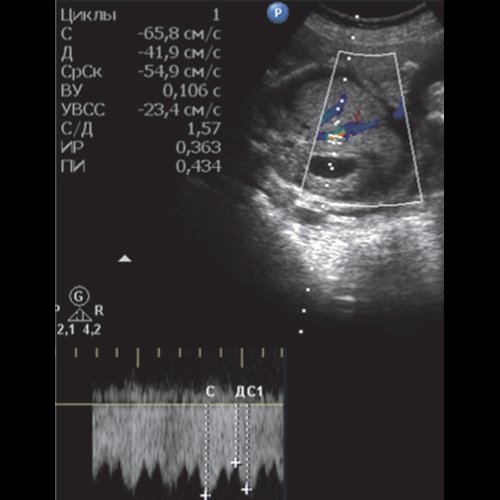 Эхограмма - гемолитическая болезнь плода у дихориальных близнецов - кровоток ВП с нормальными индексами резистентности и сниженной фазой ИВР и реверсный кровоток ВП