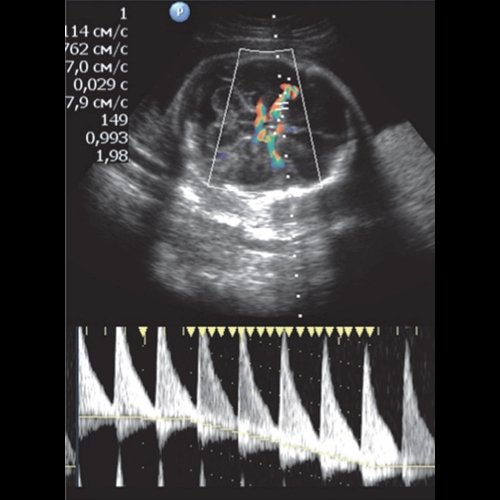 Эхограмма - гемолитическая болезнь плода - ПСС СМА - 114 см/с