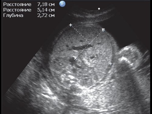 Эхограмма - гепатомегалия плода, КПР и ОПР - тяжелая гемолитическая анемия плода
