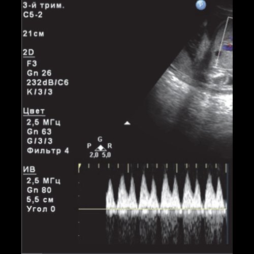 Эхограмма - гемолитическая болезнь плода - сниженная фаза изоволюметрической релаксации венозного протока