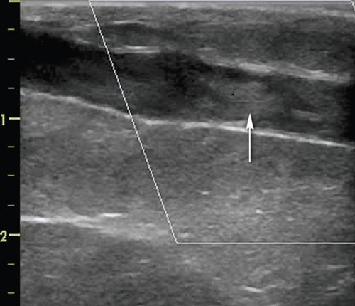 Эхограмма - тромбоз (окклюзия) шунта, средняя 1/3 бедренно-подколенного аутовенозного шунта