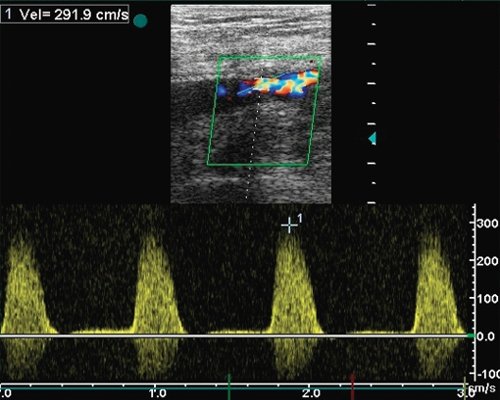 Подвздошно-бедренное шунтирование - допплерограмма кровотока из зоны стеноза