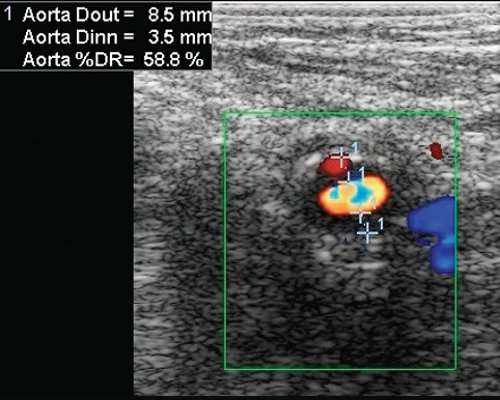 Подвздошно-бедренное шунтирование - поперечное сечение поверхностной бедренной артерии в области дистального анастомоза