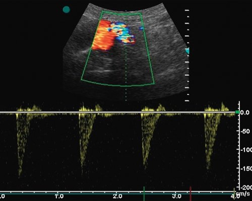 Аорто-бедренное шунтирование - допплерограмма кровотока из области перегиба
