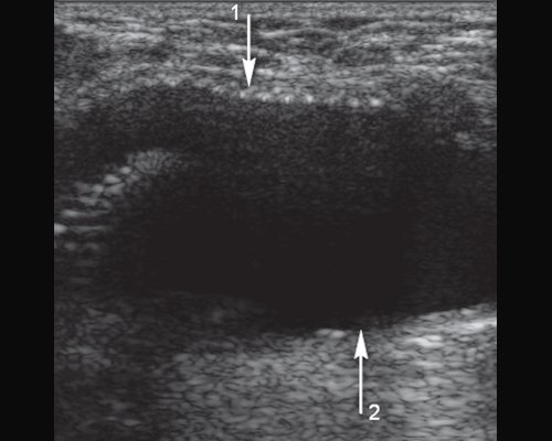 Подвздошно-бедренное шунтирование синтетическим протезом из дакрона, аневризма в области дистального анастомоза: зона дистального анастомоза, стрелка 1 - протез, стрелка 2 - расширенная общая бедренная артерия (диаметр - 17 мм)