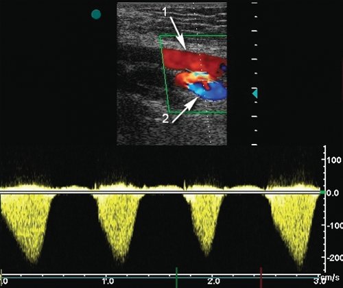 Артериовенозная фистула между поверхностной бедренной артерией и поверхностной бедренной веной - допплерограмма кровотока из области фистулы