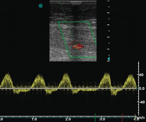 Артериовенозная фистула между поверхностной бедренной артерией и поверхностной бедренной веной - допплерограмма из поверхностной бедренной вены на 3-5 см дистальнее фистулы, характер кровотока псевдоартериальный