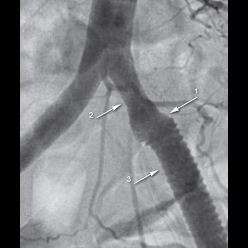 Ангиограмма - подвздошно-бедренное шунтирование, стрелка 1 - место соединения общей подвздошной артерии (стрелка 2) с протезом (стрелка 3)