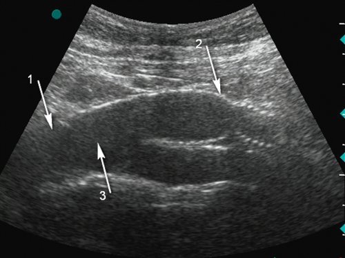 Эхограмма - аорто-бедренное шунтирование, стрелка 1 - аорта, стрелка 2 - протез, стрелка 3 - просвет между аортой и протезом