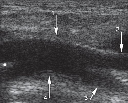 Эхограмма - подвздошно-бедренное шунтирование (продольное сечение на уровне дистального анастомоза)