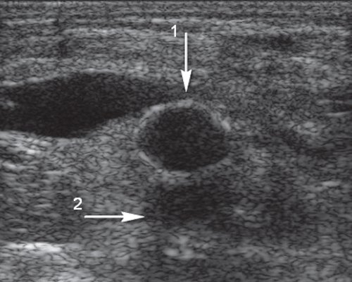 Эхограмма - подвздошно-бедренное шунтирование (поперечное сечение на 3-5 мм выше уровня дистального анастомоза )