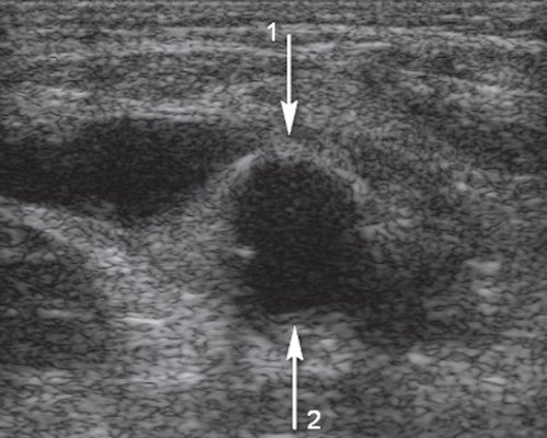 Эхограмма - подвздошно-бедренное шунтирование (поперечное сечение на уровне дистального анастомоза)