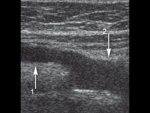 Эхограмма - бедренно-подколенное шунтирование, стрелка 1 - аутовена, стрелка 2 - подколенная артерия