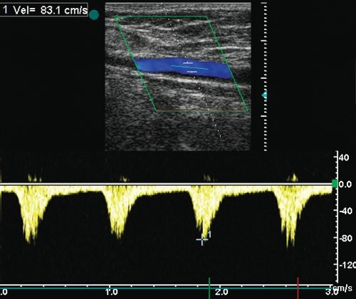 Стеноз бедренно-подколенного аутовенозного шунта - допплерограмма кровотока из шунта на 3-5 см выше зоны стеноза