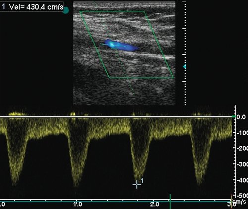 Стеноз бедренно-подколенного аутовенозного шунта - допплерограмма кровотока из зоны стеноза