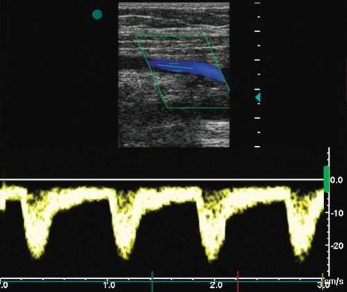 Стеноз бедренно-подколенного аутовенозного шунта - допплерограмма кровотока из шунта на 2-3 см выше уровня дистального анастомоза