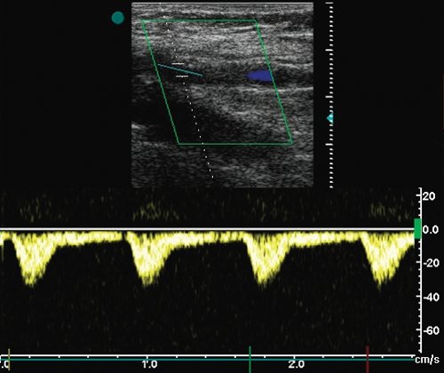 Стеноз бедренно-подколенного аутовенозного шунта - допплерограмма кровотока на 8-10 см дистальнее зоны стеноза
