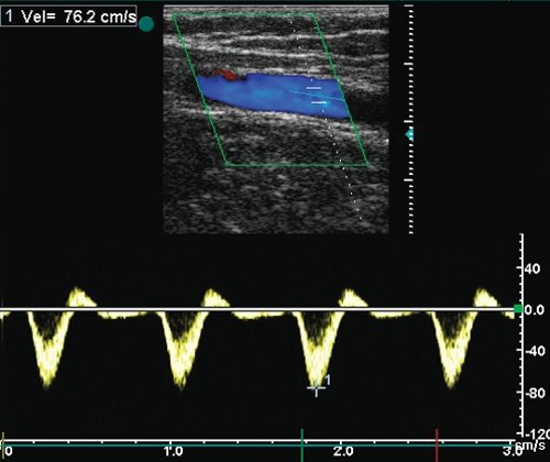 Бедренно-подколенный аутовенозный шунт без признаков стеноза - допплерограмма кровотока из средней 1/3 шунта