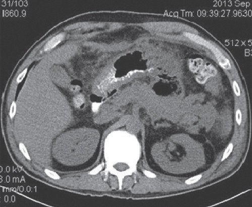 КТ брюшной полости - после оперативного лечения и удаления дренажей