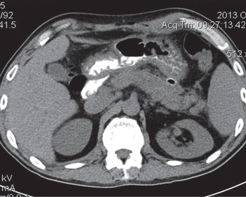 КТ (нативная фаза) - после лечения острого панкреатита, поджелудочная железа с четкими, ровными контурами, мелкие жидкостные образования в проекции хвоста ПЖ (синяя стрелка)