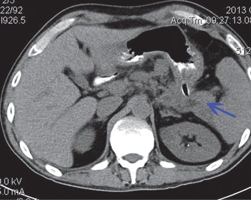КТ (нативная фаза) - после лечения острого панкреатита, поджелудочная железа с четкими, ровными контурами, мелкие жидкостные образования в проекции хвоста ПЖ (синяя стрелка)