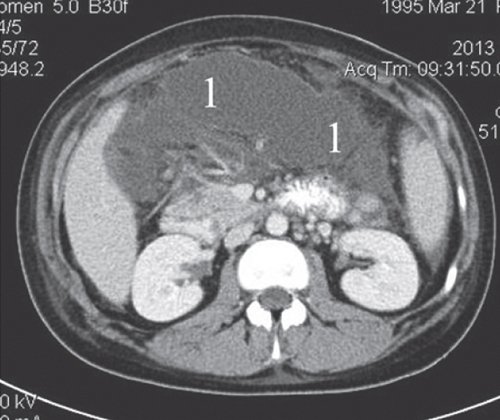 КТ (после контрастирования) - жидкостное образование в сальниковой сумке (1) распространяющееся на область хвоста железы и на забрюшинную клетчатку до уровня верхнего полюса левой почки