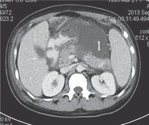 КТ (после контрастирования) - жидкостное образование в сальниковой сумке (1) распространяющееся на область хвоста железы и на забрюшинную клетчатку до уровня верхнего полюса левой почки
