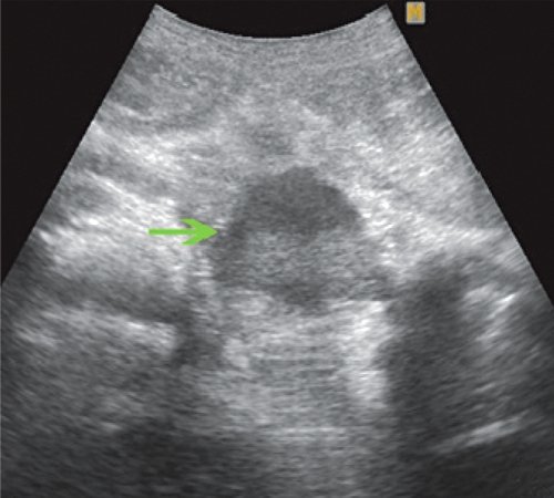 Эхограмма - постнекротическая киста поджелудочной железы в I стадии развития, в сальниковой сумке в проекции тела ПЖ визуализируется жидкостное образование неправильной формы, без четкой капсулы, с гиперэхогенной взвесью внутри (зеленая стрелка)