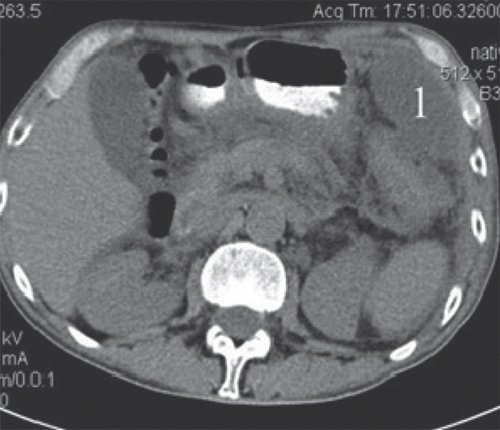 КТ - острый панкреатит с формированием отграниченного скопления жидкости в брюшной полости (нативная фаза)