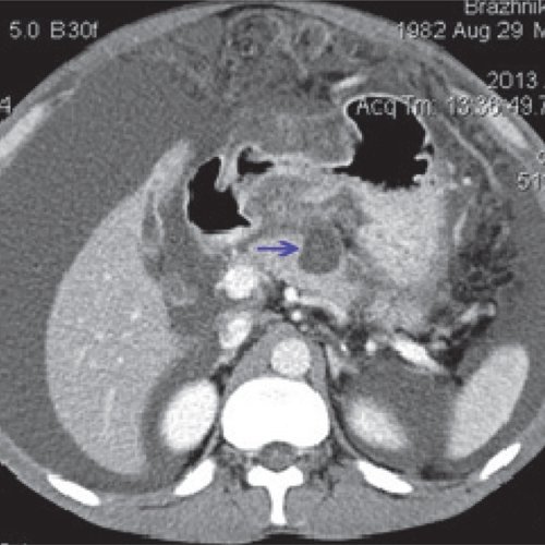 КТ - острый панкреатит с формированием псевдокисты поджелудочной железы (после контрастирования)