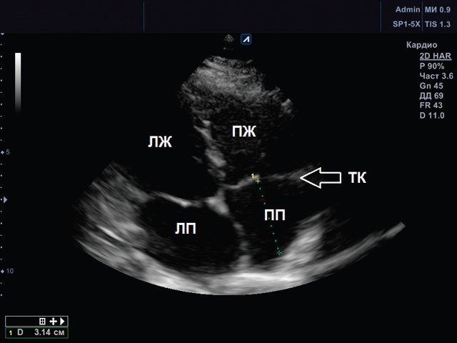 ЭХОКГ правого предсердия, ТК - трикуспидальный клапан