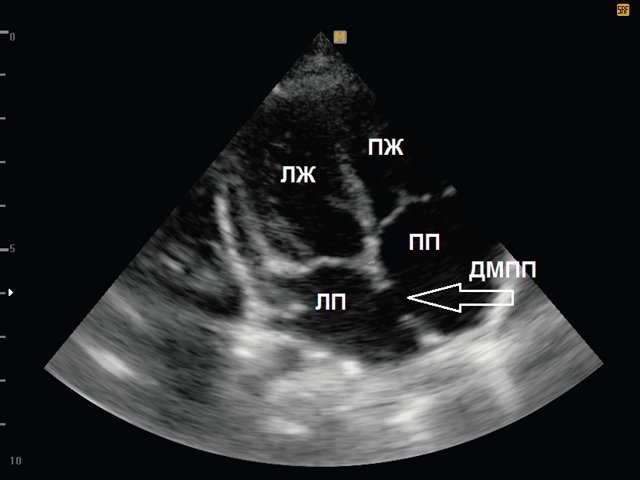 ЭХОКГ правого предсердия, ДМПП - дефект межпредсердной перегородки