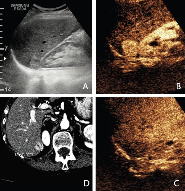 Солидное неоднородное очаговое образование в VII сегменте печени (А). При УЗИ с контрастированием образование выглядит гиперваскулярным в артериальную фазу (В). На поздней фазе в нем присутствует эффект вымывания (С). Соответствующая артериальная фаза на МСКТ с контрастированием (D)