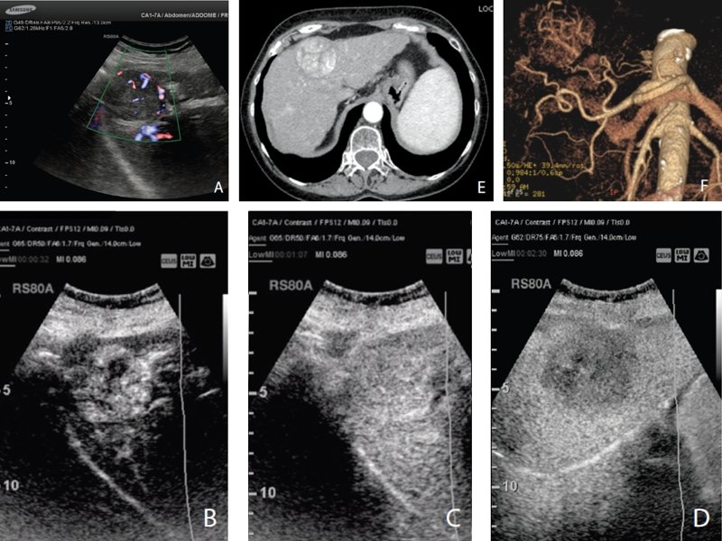 Солидное и неоднородное узловое образование с признаками интра- и перинодулярного кровотока в режиме энергетического допплера, расположенное в правой доле печени (А). УЗИ с контрастированием демонстрирует интенсивное артериальное усиление (В) с постепенным и замедленным вымыванием (C), которое становится более очевидным в позднюю фазу (D). МСКТ с контрастированием в аксиальной плоскости в артериальной фазе (Е) и реконструкция в режиме MIP-3D (F) выявляют диагностические признаки, соответствующие печеночно-клеточному раку.
