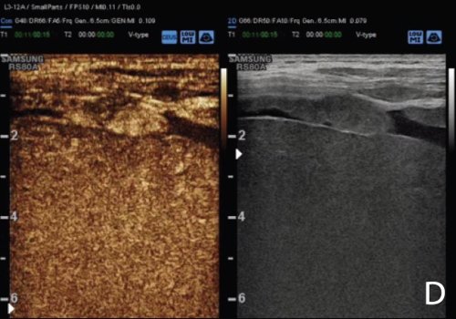 УЗИ узелкового образования на брюшине с контрастированием (D - поздняя фаза)