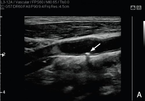 УЗИ сонной артерии в В-режиме (A)