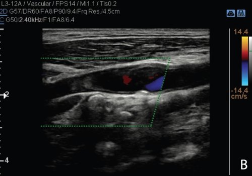 УЗИ сонной артерии в режиме ЦДК (B)