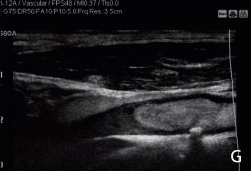 УЗИ сонной артерии в режиме контрастирования - полная окклюзия внутренней сонной артерии (G)