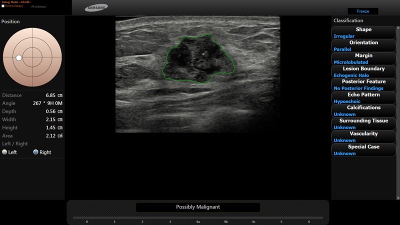 Программа S-Detect Breast - ультразвуковая диагностика образований молочной железы у женщин