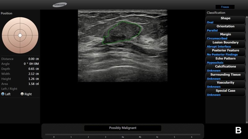 Программа S-Detect Breast - фиброаденома