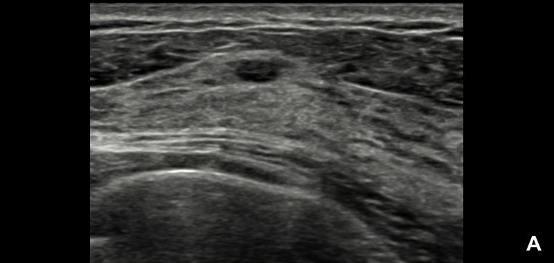 УЗИ молочной железы - доброкачественное узелковое образование (категория 3 по BI-RADS®)