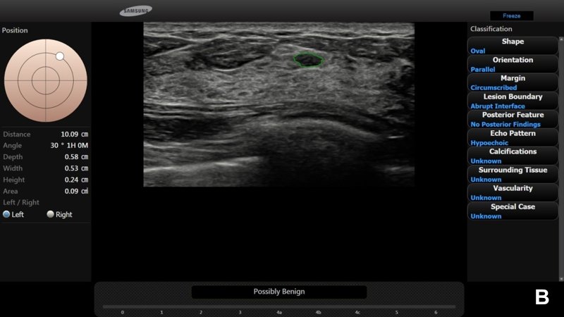 Программа S-Detect Breast - доброкачественное узелковое образование (категория 3 по BI-RADS®)