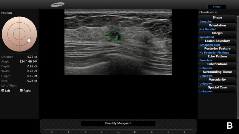 Программа S-Detect Breast - лучевой рубец (категория 4В по BI-RADS®)