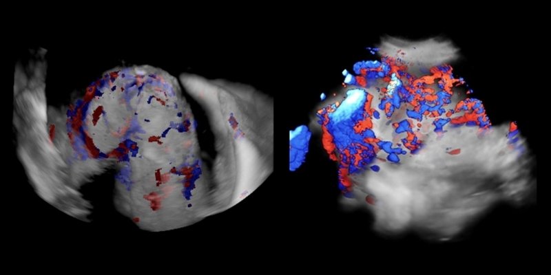 Трехмерная ультразвуковая виртуальная цистоскопия - исследование матки в режиме 3D + цветное картирование + See-Thru